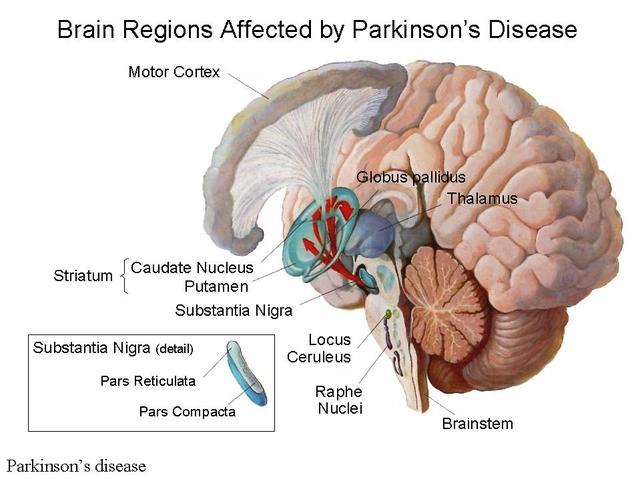 parkinson's disease